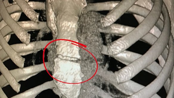 Medical images of the crack in Caroline Buchanan's sternum. Photo: Supplied