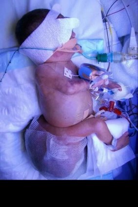 Aleyathiah Wilcockson was born weighing 900 grams with a 1.2-kilogram tumour below her tailbone