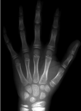 X-rays of wrists were used to determine the age of those accused in people-smuggling cases, a method that is discredited.