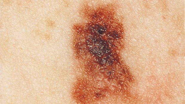 A typical image of a thin, invasive melanoma.

