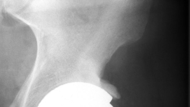 The Implant Files Hip Replacement Failures Trigger New Class Action Fears