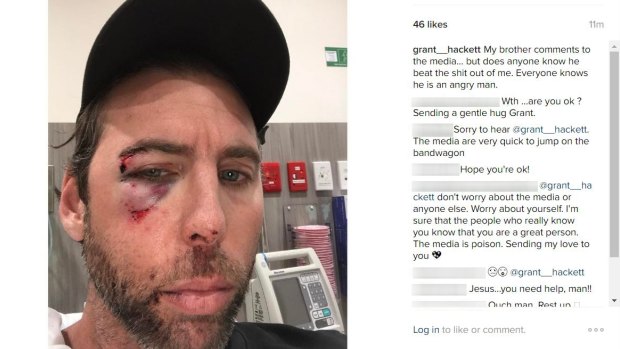 Grant Hackett posted an image of himself to social media, his face bloody and bruised.