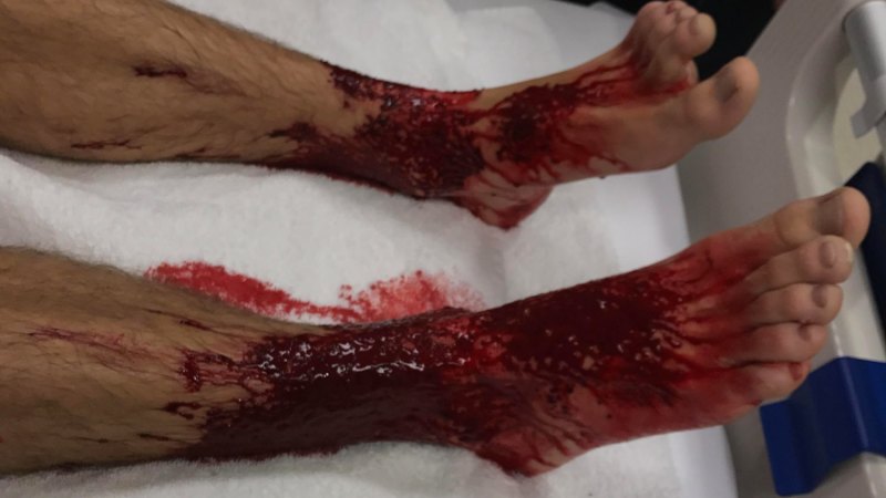 It's not a movie: Did marine critters eat Brighton teenager's legs?