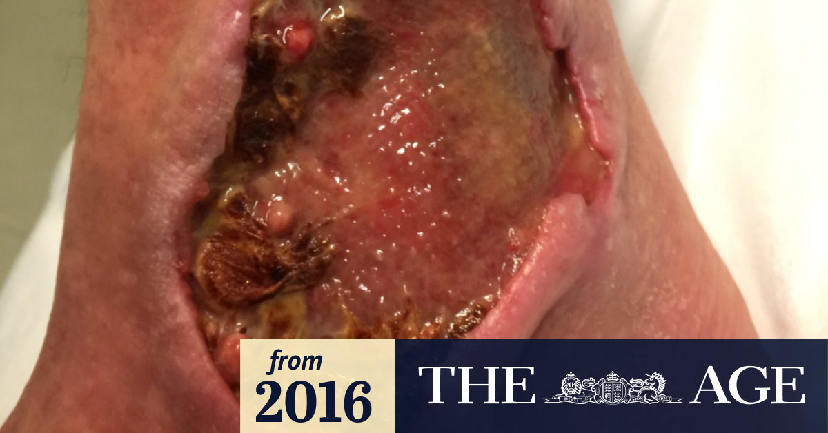 Flesh-eating Buruli ulcer cases soar as disease spreads to Melbourne