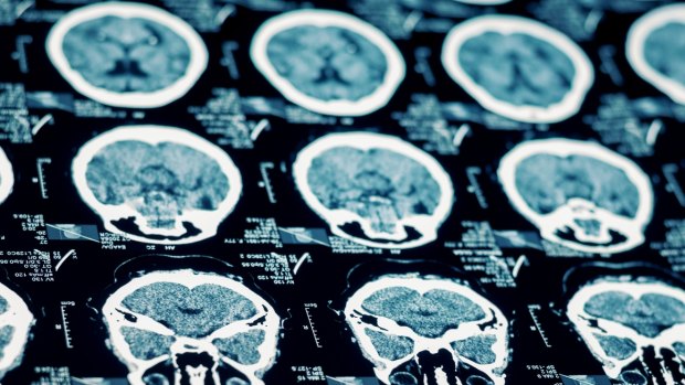 If one part of the brain is injured, the right hemisphere may overcompensate, leading to an increased focus on maths and the arts, US psychologist Joanne Ruthsatz says.