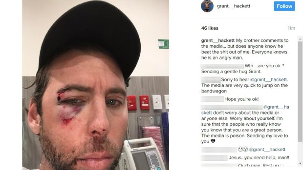 Grant Hackett posted an image of himself to social media on Thursday, his face bloody and bruised.