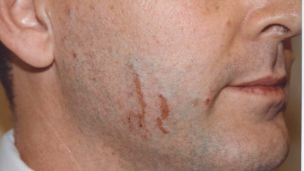 The marks on Gerard Baden-Clay's face.