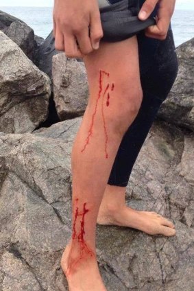 The injuries sustained by Cameron Pearman when he was bitten by a shark at Port Bouvard on Saturday morning.