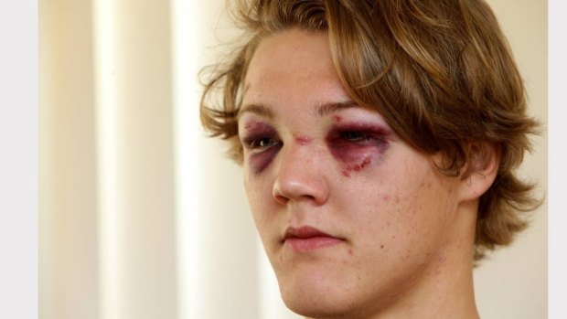 Jesse Chapman was left with facial injuries after the unprovoked attack. 