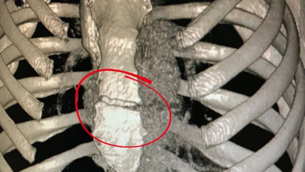 Medical images of the crack in Caroline Buchanan's sternum. Photo: Supplied