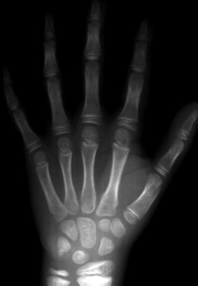 X-rays of wrists were used to determine the age of those accused in people-smuggling cases, a method that is discredited.