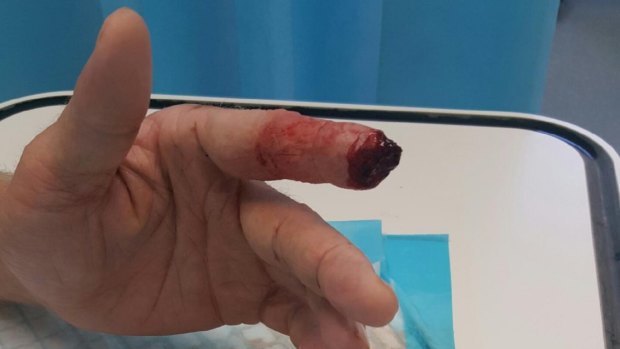 Ginninderra cricketer James Coate got his finger caught in the rollerdoor opening the club's canteen.