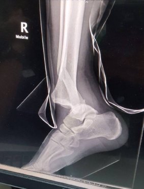 An X-ray of  Daniel Vasjuta's broken leg
