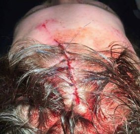 Blake Everett needed seven stitches after he was assaulted in Frankston.