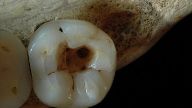 Earliest evidence of dental caries manipulation.