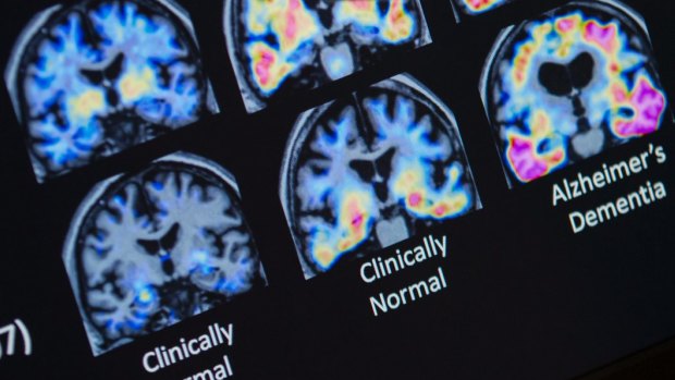 First new Alzheimer’s drugs in 20 years to bring hope for early-stage patients
