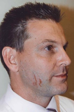 Scratches on Gerard Baden-Clay's face  provided crucial evidence during his murder trial.