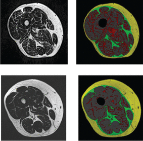 Magnetic resonance imaging shows fat distribution of two participants: yellow is subcutaneous fat, green is subfascial fat/beneath the fascia, red is intramuscular fat.