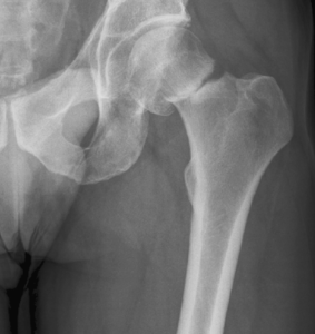 Hip fractures, and other common breaks, are predicted to increase with the ageing population. 
