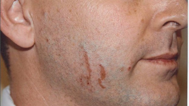 Police photographs of marks on Gerard Baden-Clay's face.