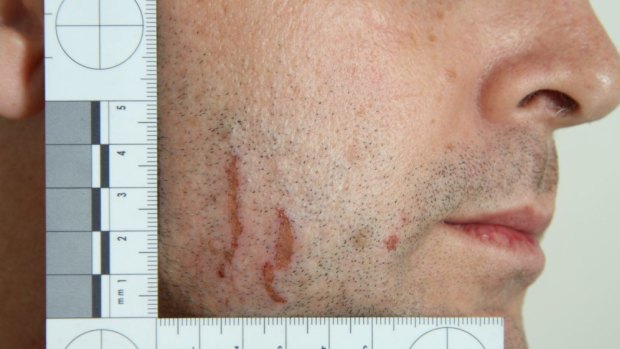 The most damning evidence against accused killer Gerard Baden-Clay are the scratches on his face, according to the prosecution.