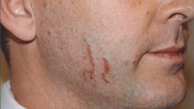 Police photographs of marks on Gerard Baden-Clay's face.