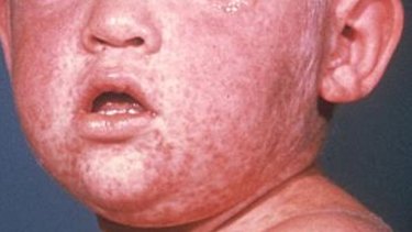 The measles rash on the face of a child.