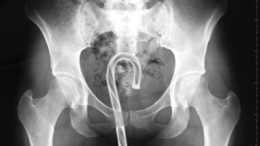 toothpick stuck in throat