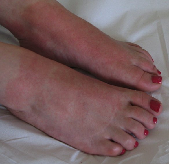Protective compound added to skin cells helps body fight eczema ...