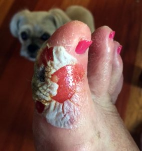 The toe was wrongly dressed after it was injured with a scalpel.