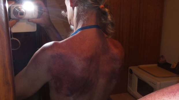 A follower shows bruising to his back as a result of slapping, or what Mr Xiao calls paida.