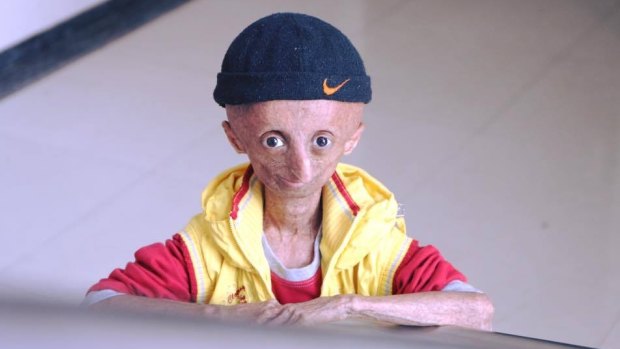 Nihal Bitla, who has died aged 15, suffered from progeria, which causes accelerated ageing.  
