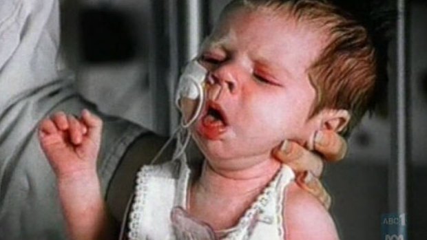 A baby with whooping cough.