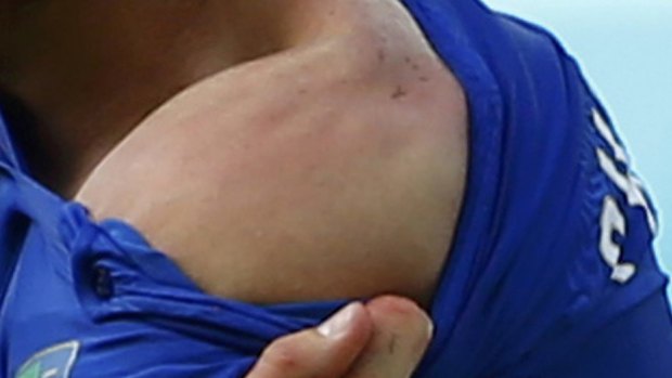 Suarez bite: Giorgio Chiellini reveals teeth marks on his shoulder.