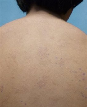 An undated photo provided by the American Academy of Pediatrics shows a rash on an unidentified 11-year old boy from a nickel allergy.