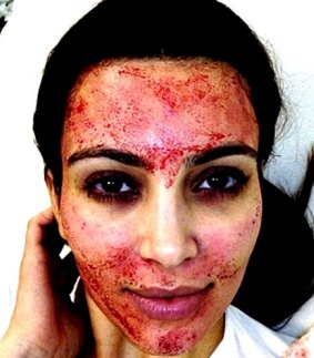 Kim Kardashian shared this picture of her having a "vampire" facial on Instagram, sparking increased demand for the procedure. 