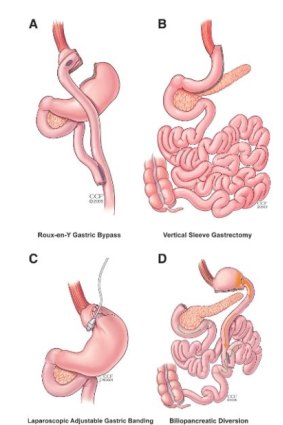 Surgery options to treat type 2 diabetes.