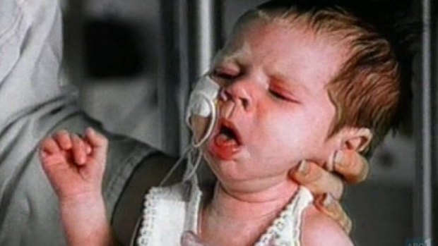A baby with whooping cough.