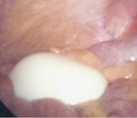 The lump, which resembles a boiled egg, inside the patient's stomach.