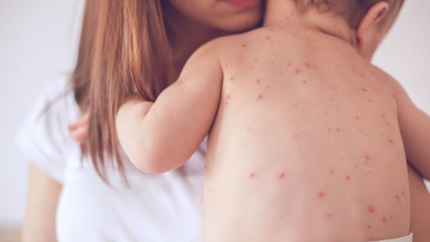 Four cases of measles have been confirmed in Victoria. 