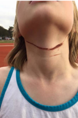 The cut on Devon's neck.