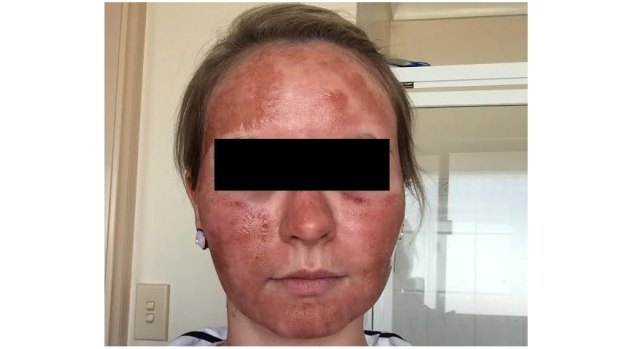 A woman's face the day after she received laser resurfacing treatment from the Lumps & Bumps clinic.