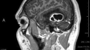 The black area indicates the cerebral abscess inside Laurie Gilbert's brain.