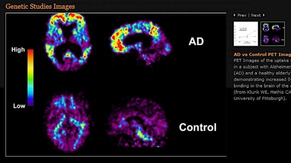 Scans of Alzheimer's sufferer brain, top, and a normal brain, below. 