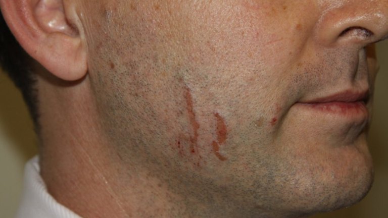 Gerard Baden-Clay trial: Facial injuries 'very typical' of fingernail  scratches