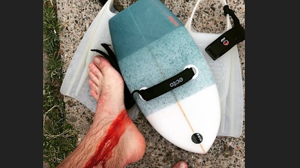 A photo of the bodysurfer's injuries.