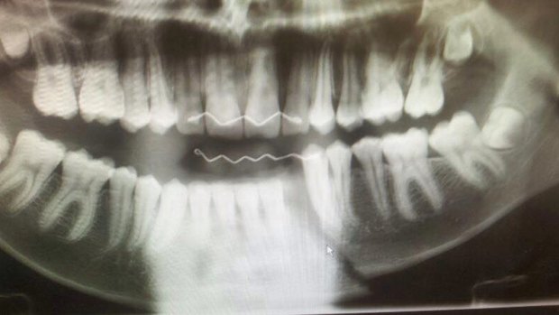 An x-ray showing the fractured jaw of a young soccer player who was injured in an on-field fight.