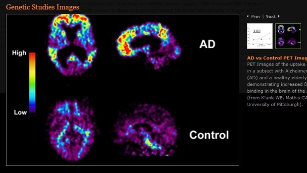 Scans of Alzheimer's sufferer brain, top, and a normal brain, below. 