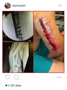 Ben Ross shared images of his broken arm after surgery with his Instagram followers.