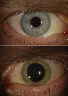 Dr Crozier's eye changed colour from blue (top) to green, then back again. 